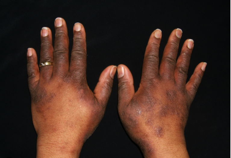 Eczema on hands