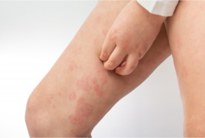 eczema on legs