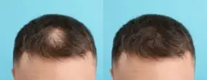 Hair Loss Before and After